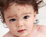 La varicela y el sarampión